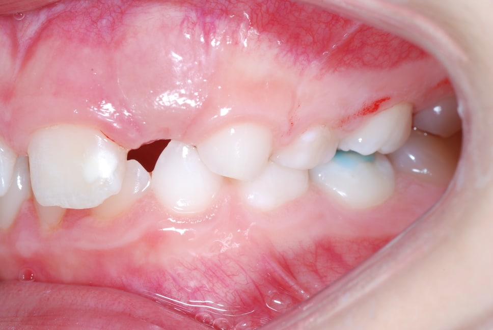 Traumatologia dentária